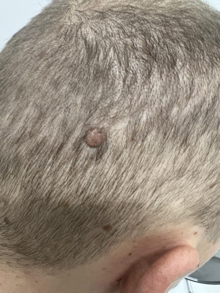 Удаление себорейной кератомы