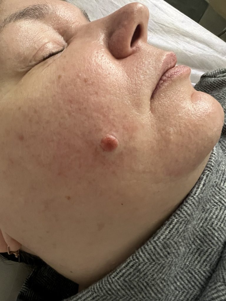 Удаление внутридермального невуса